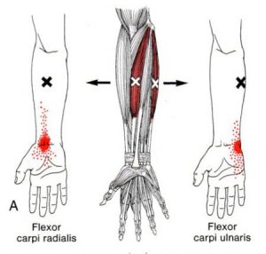 Flexor carpi radialis a ulnaris spoušťový bod