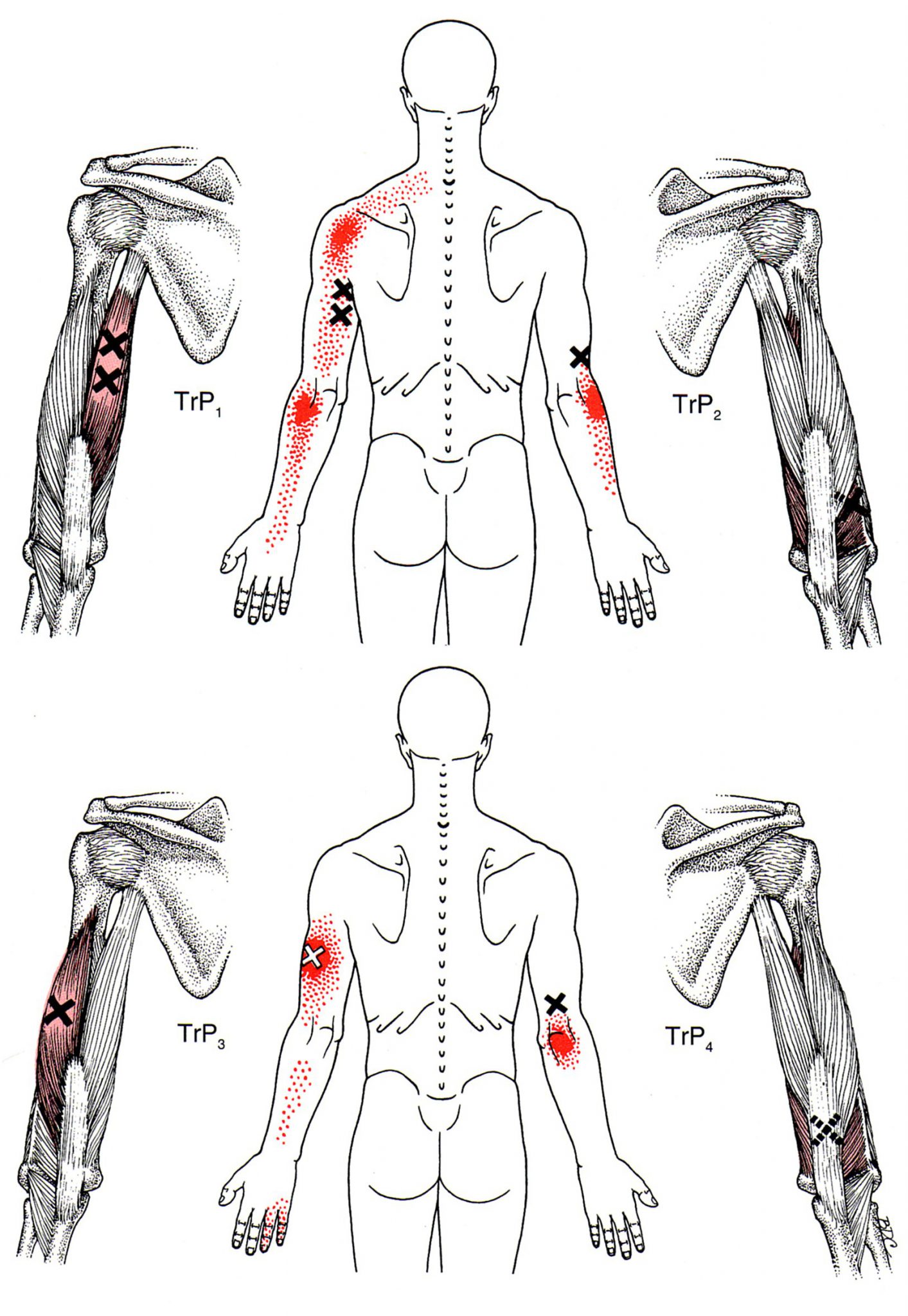 musculus-triceps-brachii-a-musculus-anconeus-spou-ov-bod