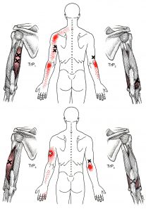 Triceps brachii spoušťový bod, pohled zezadu
