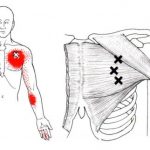 Pectoralis major spoušťový bod, sternální část