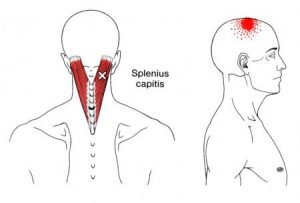 Splenius capitis spoušťový bod