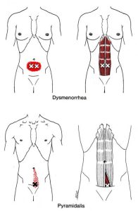 Pyramidalis a spoušťový bod způsobující dysmmenorrheu