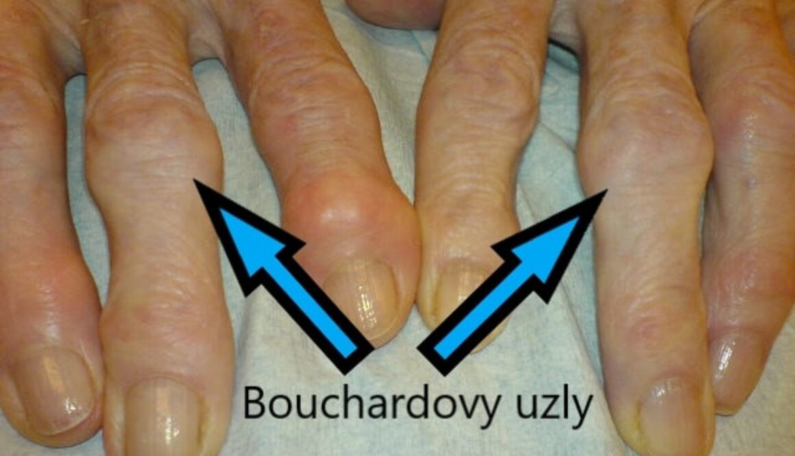 Bouchardovy uzly - foto