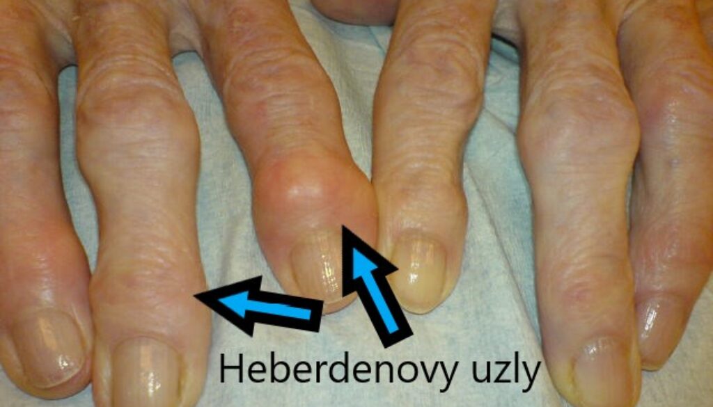 Heberdenovy uzly - foto
