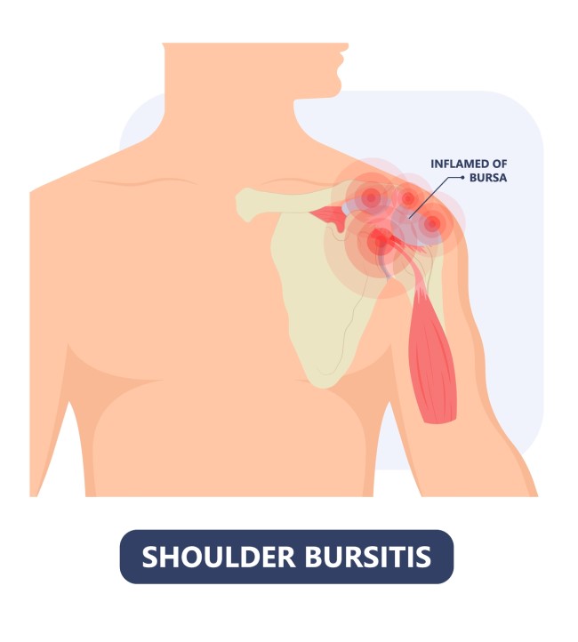 Bursitida ramene – příznaky, příčiny, diagnostika a léčba