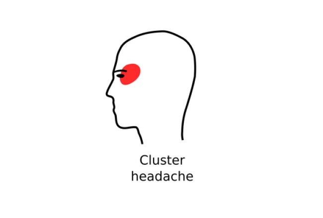 Cluster Headache – příčiny, příznaky a léčba (2024)