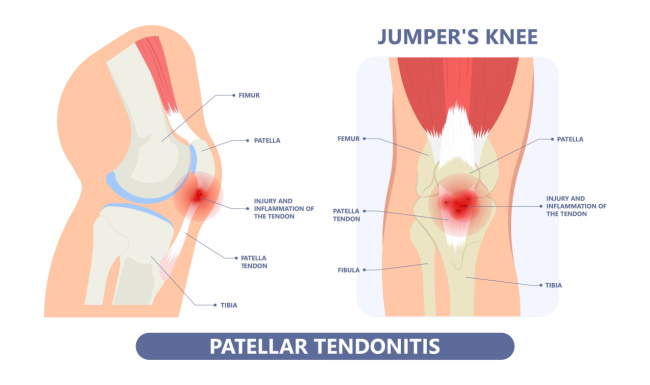 Skokanské koleno – příčiny, příznaky a léčba