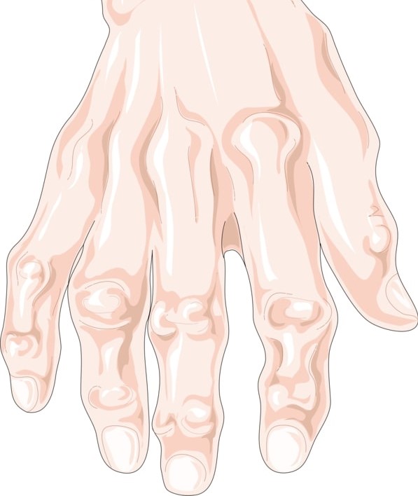 Artróza prstů ruky – příčiny, příznaky a léčba