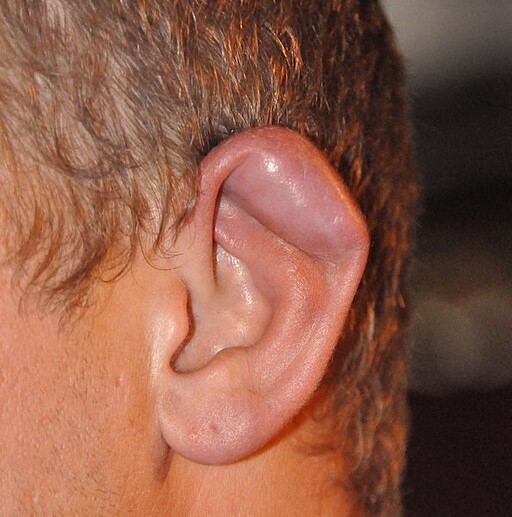 Květákové (karfiolové) ucho – příčiny, příznaky a léčba
