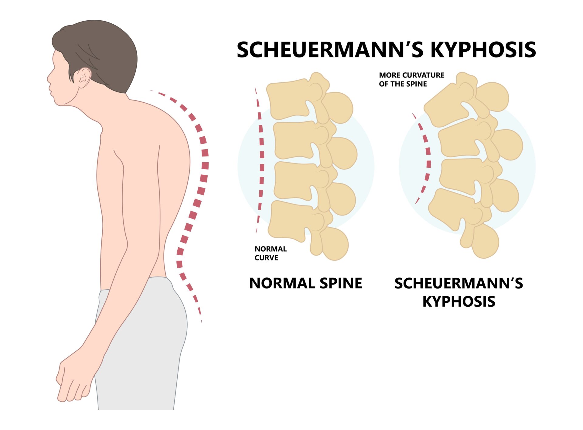 Scheuermannova choroba – příčiny, příznaky a léčba