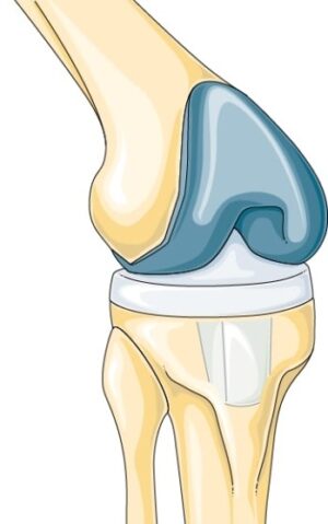 Totální endoprotéza kolenního kloubu (TEP kolene)